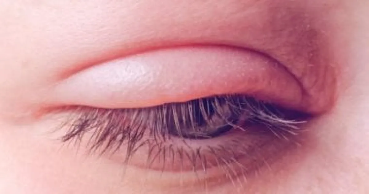 الكيس الدهني في الجفن: ما هو وكيف تتخلص منه؟