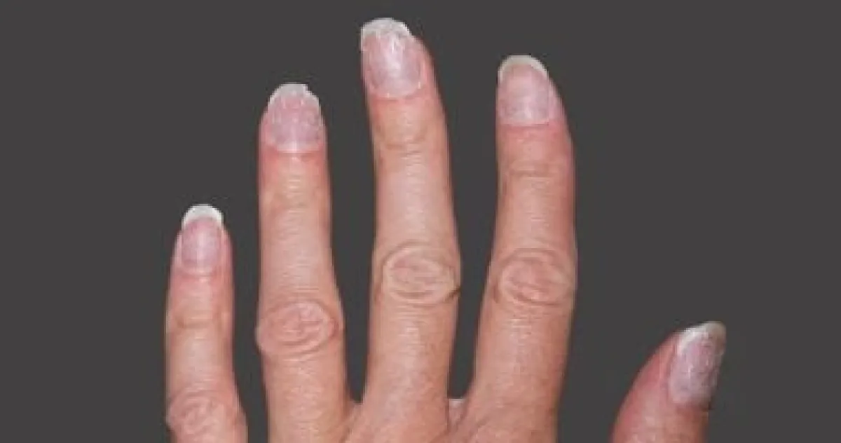 لون أظافرك يكشف أسرار صحتك: متى يجب أن تقلق وتزور الطبيب؟