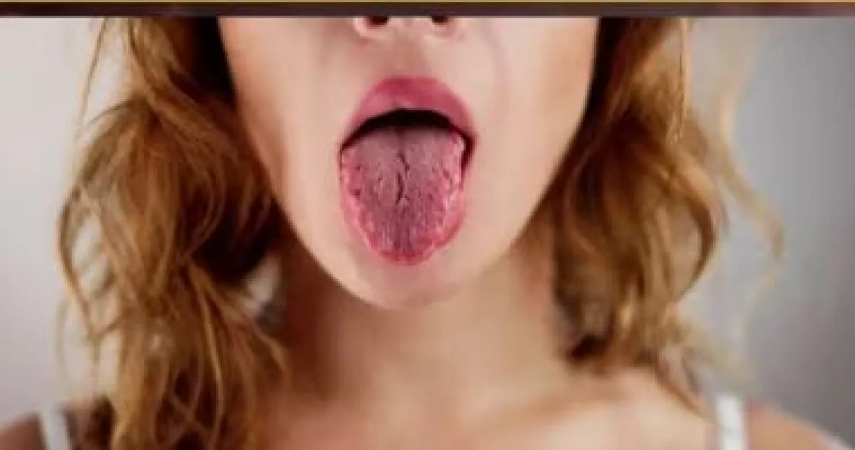 علامات تحذيرية على اللسان: متى تتحول بثور الفم إلى خطر سرطان؟