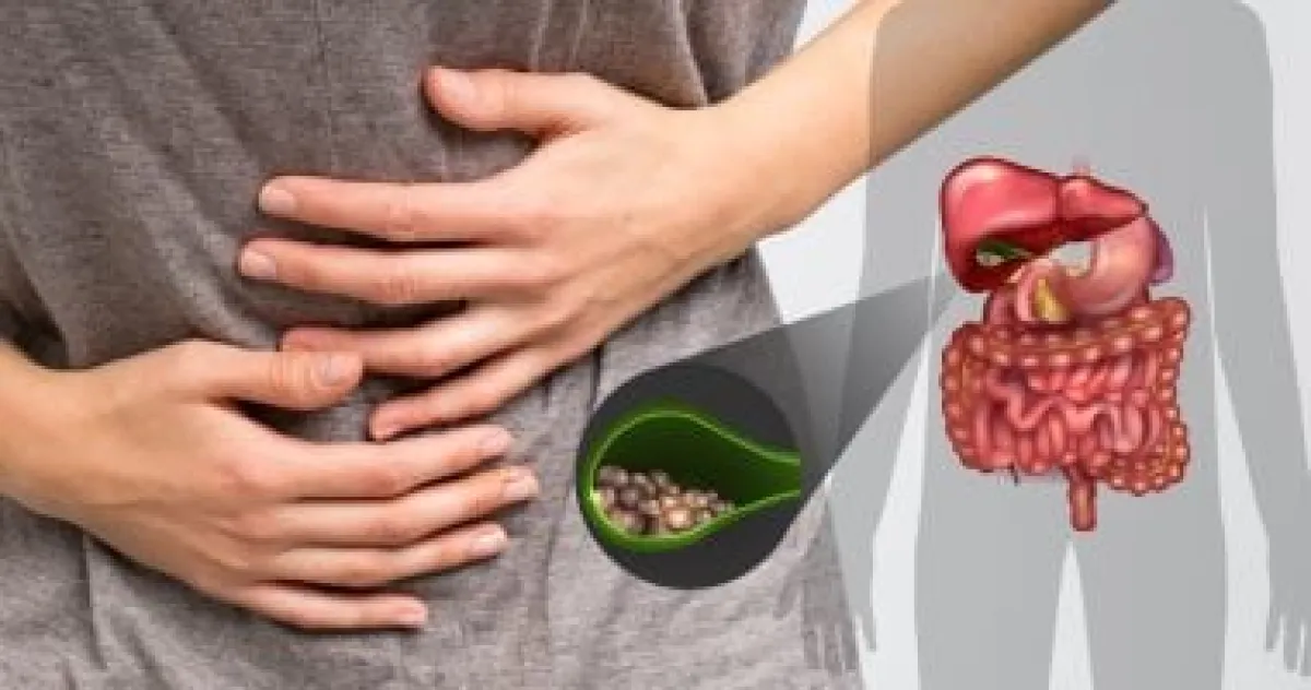 السمنة وحصوات المرارة: كيف يرتبط الوزن الزائد بتكوّن الحصوات؟