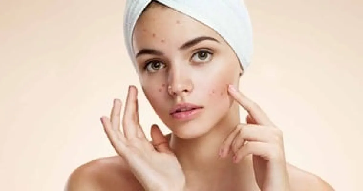 حب الشباب الهرموني: طبيبة تكشف سر ظهور الحبوب المؤلمة قبل الدورة الشهرية