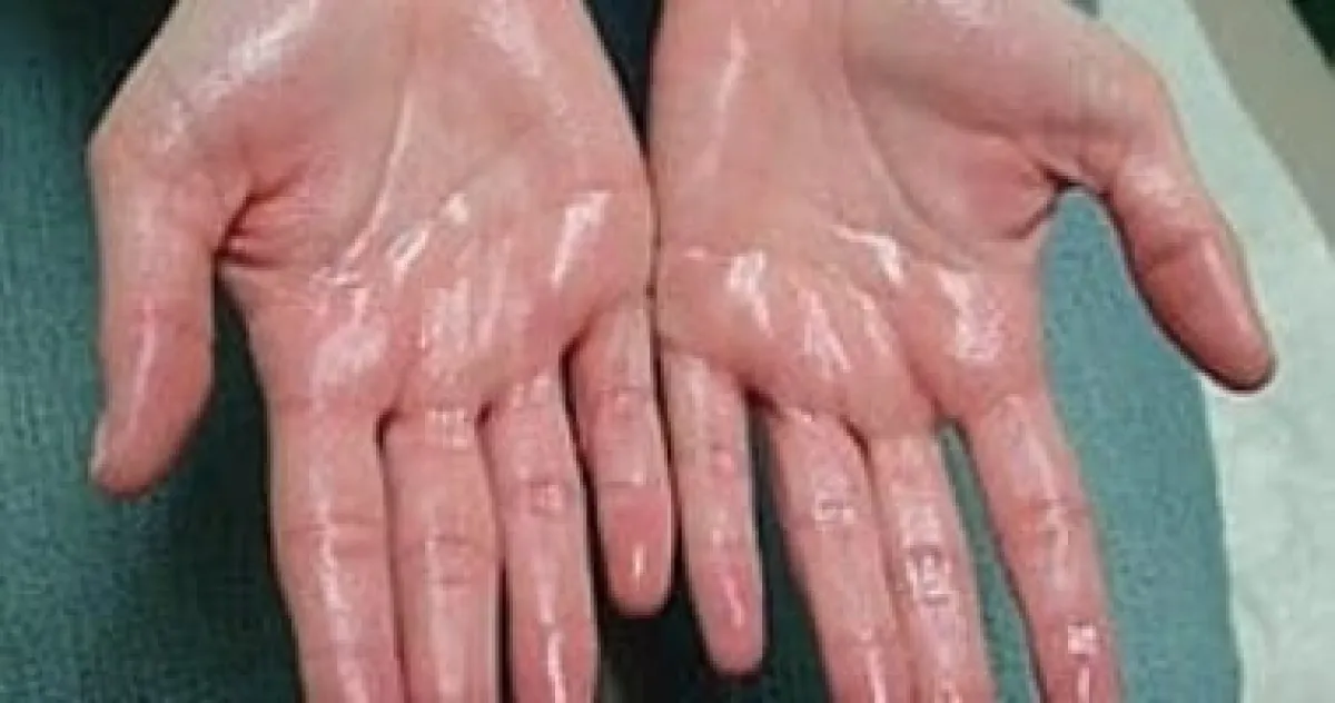 تعرق اليدين والقدمين: متى يتحول الأمر إلى "فرط تعرق" يستدعي العلاج؟