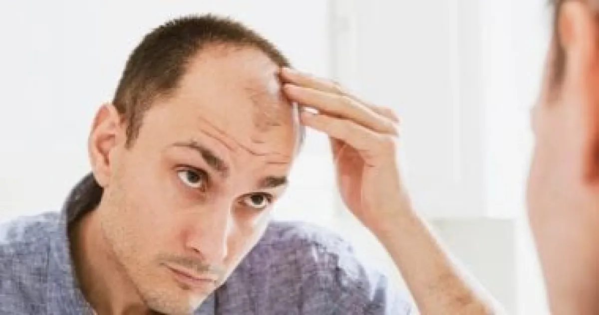 دراسة تربط الصلع الذكوري بتدهور صحة الأمعاء: هل الهضم هو السبب الخفي؟