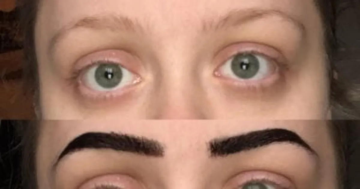 ترقق الحواجب الخارجي؟ قد يكون "علامة هيرتوغ" تحذيراً بنقص اليود